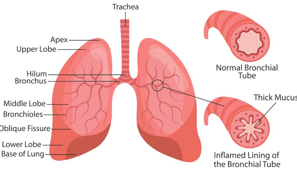 Bronchitis